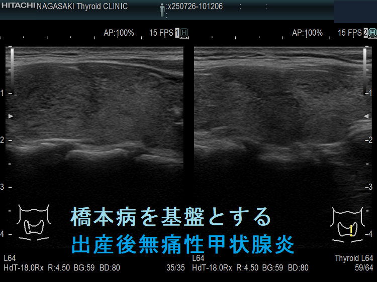 橋本病を基盤とする出産後無痛性甲状腺炎(矢状断) 橋本病を基盤とする出産後無痛性甲状腺炎(矢状断)