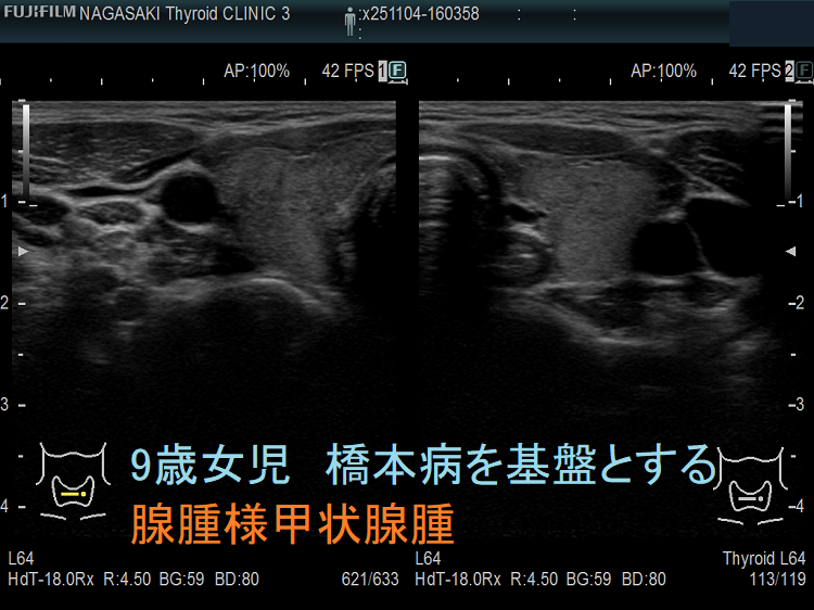 9歳女児 橋本病を基盤とする腺腫様甲状腺腫(水平断) 9歳女児 橋本病を基盤とする腺腫様甲状腺腫(水平断)