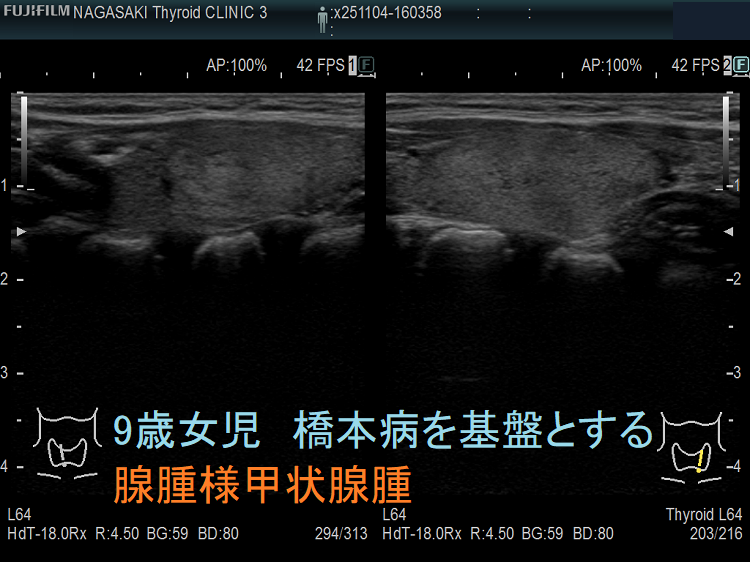 9歳女児 橋本病を基盤とする腺腫様甲状腺腫(矢状断) 9歳女児 橋本病を基盤とする腺腫様甲状腺腫(矢状断)