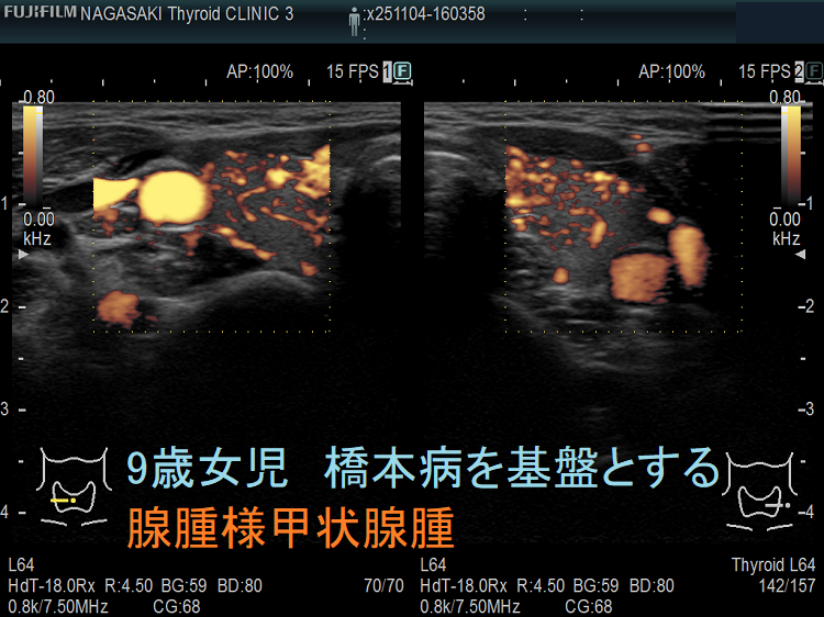 9歳女児 橋本病を基盤とする腺腫様甲状腺腫 ドプラーモード 9歳女児 橋本病を基盤とする腺腫様甲状腺腫 ドプラーモード