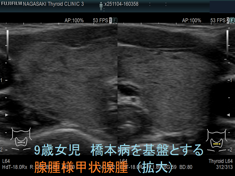 9歳女児 橋本病を基盤とする腺腫様甲状腺腫(拡大) 9歳女児 橋本病を基盤とする腺腫様甲状腺腫(拡大)