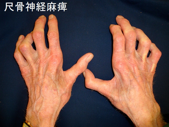 尺骨神経麻痺 尺骨神経麻痺