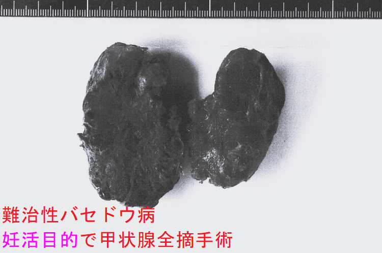 難治性バセドウ病 妊活目的で甲状腺全摘手術標本(裏) 難治性バセドウ病 妊活目的で甲状腺全摘手術標本(裏)