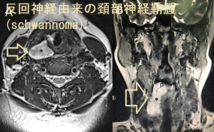 反回神経由来の頚部神経鞘腫(schwannoma) MRI画像 反回神経由来の頚部神経鞘腫(schwannoma) MRI画像