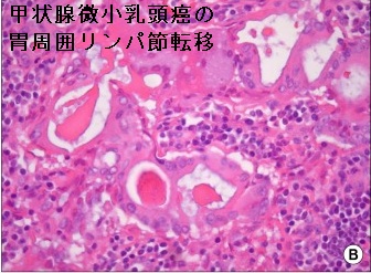甲状腺微小乳頭癌の胃周囲リンパ節転移 甲状腺微小乳頭癌の胃周囲リンパ節転移