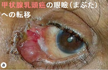 甲状腺乳頭癌の眼瞼(まぶた)への転移 甲状腺乳頭癌の眼瞼(まぶた)への転移