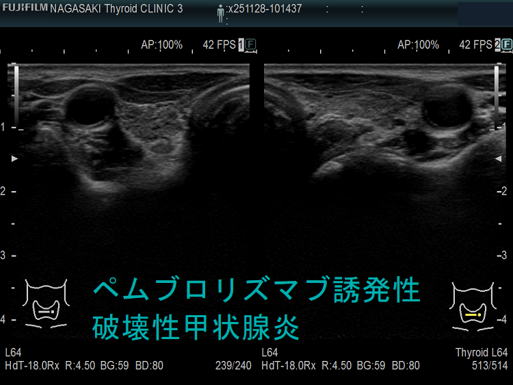 ペムブロリズマブ誘発性破壊性甲状腺炎 末期 ペムブロリズマブ誘発性破壊性甲状腺炎 末期