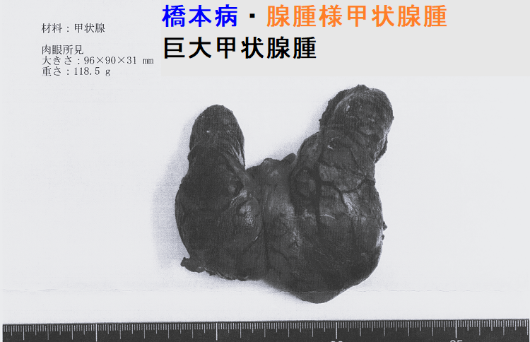 橋本病・腺腫様甲状腺腫 巨大甲状腺腫 摘出標本 橋本病・腺腫様甲状腺腫 巨大甲状腺腫 摘出標本