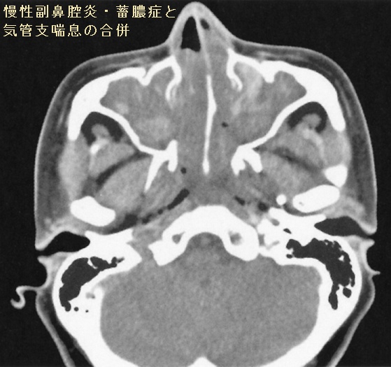 慢性副鼻腔炎・蓄膿症と気管支喘息の合併 副鼻腔単純CT 水平断像 慢性副鼻腔炎・蓄膿症と気管支喘息の合併 副鼻腔単純CT 水平断像