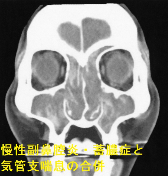 慢性副鼻腔炎・蓄膿症と気管支喘息の合併 副鼻腔単純CT 冠状断像 慢性副鼻腔炎・蓄膿症と気管支喘息の合併 副鼻腔単純CT 冠状断像