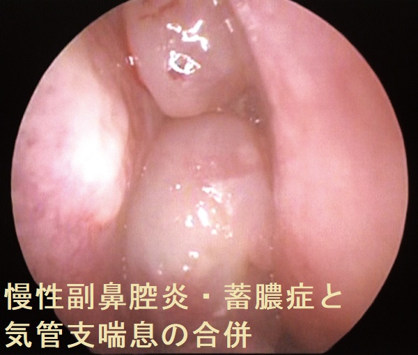 慢性副鼻腔炎・蓄膿症と気管支喘息の合併 鼻腔の内視鏡像 慢性副鼻腔炎・蓄膿症と気管支喘息の合併 鼻腔の内視鏡像