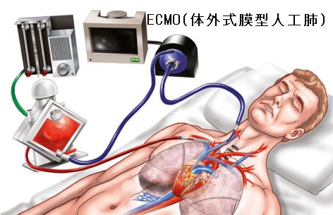 ECMO（体外式膜型人工肺）