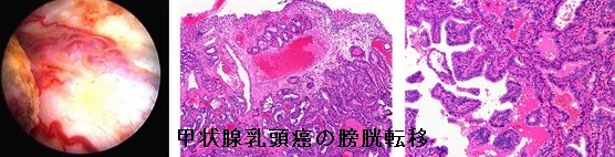 甲状腺乳頭癌の膀胱転移
