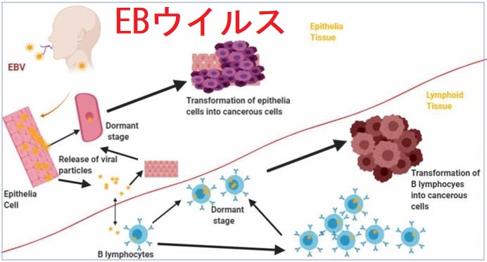 ヘルペスウイルスの一種、エプスタイン‐バールウイルス (EBV) でバセドウ病発症