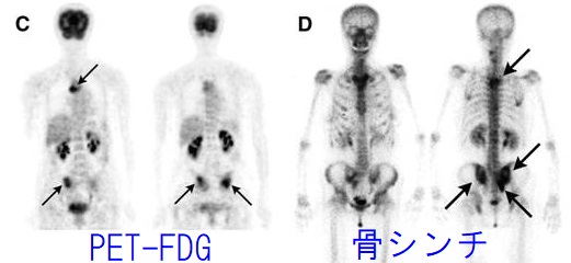 甲状腺分化癌(乳頭癌・濾胞癌）骨転移 骨シンチ PET-FDG