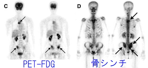 症状 骨 転移