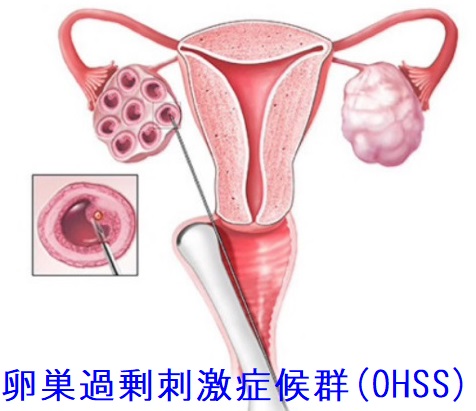 卵巣過剰刺激症候群（OHSS）