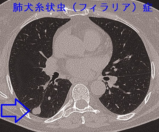 肺犬糸状虫（フィラリア）症 CT画像