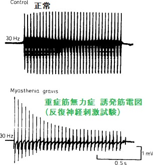 筋 症状 重症 無力 症