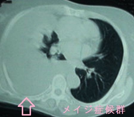 メイジ症候群 肺CT画像