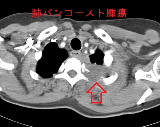 パンコースト腫瘍　CT画像