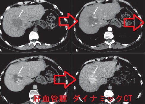 肝血管腫 肝細胞癌 肝膿瘍と甲状腺 甲状腺専門医 橋本病 バセドウ病 長崎甲状腺クリニック 大阪