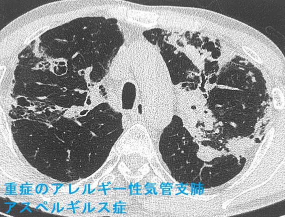 重症のアレルギー性気管支肺アスペルギルス症