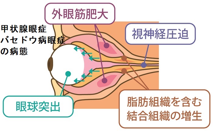 甲状腺眼症