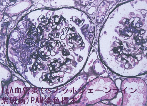IgA血管炎(ヘノッホシェーンライン紫斑病) PAM染色標本
