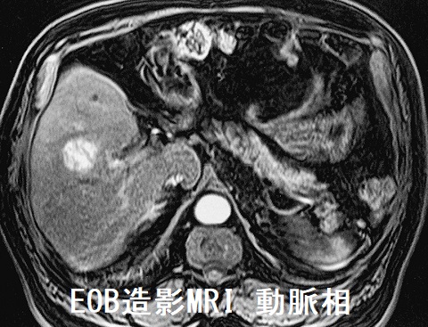 EOB造影MRI 動脈相