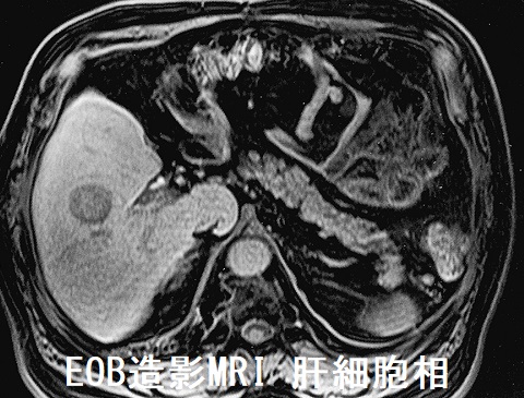 EOB造影MRI 肝細胞相