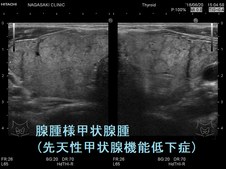 腺腫様甲状腺腫(先天性甲状腺機能低下症) 超音波(エコー)画像（水平断）