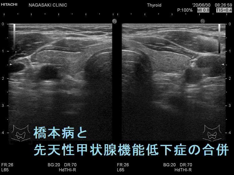橋本病と先天性甲状腺機能低下症の合併 超音波(エコー)画像