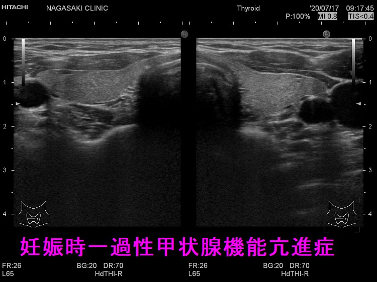 妊娠時一過性甲状腺機能亢進症の超音波(エコー)画像