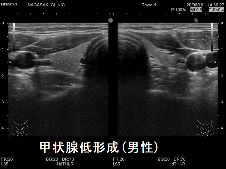 甲状腺低形成(男性)　超音波(エコー)画像