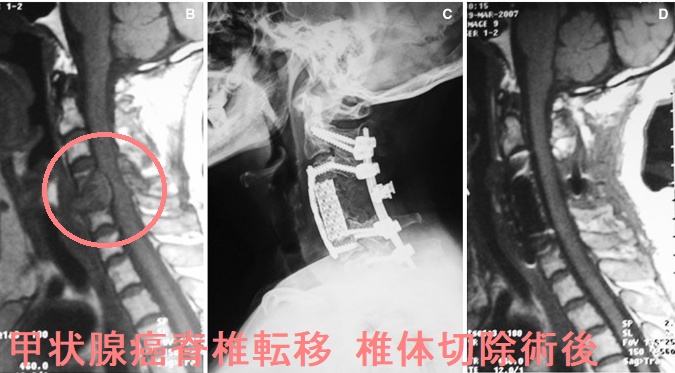甲状腺癌脊椎転移 脊体切除術後 甲状腺癌脊椎転移 脊体切除術後