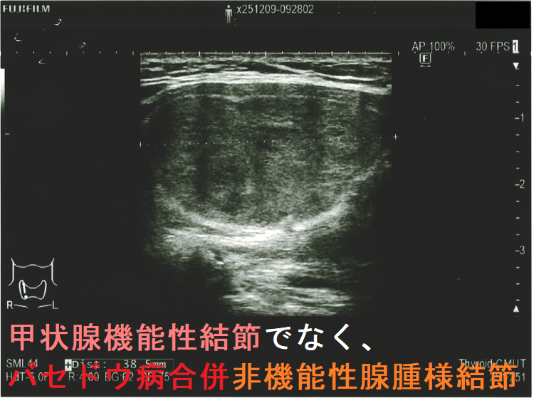 甲状腺機能性結節(機能性甲状腺腫)でなく、バセドウ病合併非機能性腺腫様結節 超音波(エコー)画像 (矢状断) 甲状腺機能性結節(機能性甲状腺腫)でなく、バセドウ病合併非機能性腺腫様結節 超音波(エコー)画像 (矢状断)