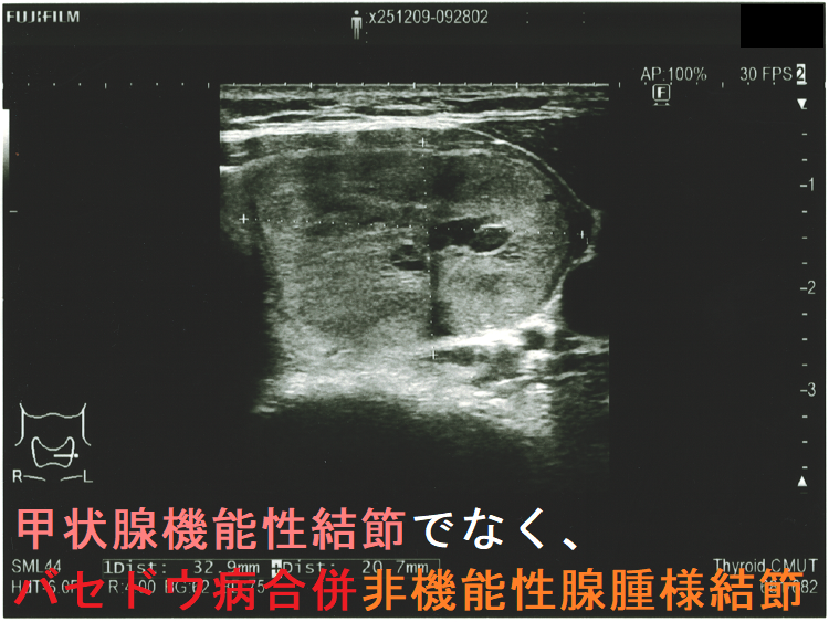 甲状腺機能性結節(機能性甲状腺腫)でなく、バセドウ病合併非機能性腺腫様結節 超音波(エコー)画像 (水平断) 甲状腺機能性結節(機能性甲状腺腫)でなく、バセドウ病合併非機能性腺腫様結節 超音波(エコー)画像 (水平断)