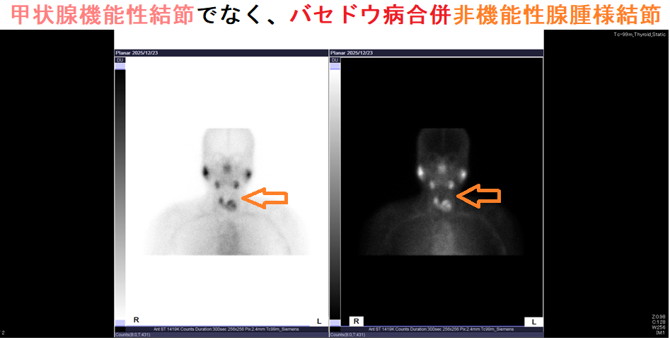甲状腺機能性結節でなく、バセドウ病合併非機能性腺腫様結節 99mTCシンチグラフィー 甲状腺機能性結節でなく、バセドウ病合併非機能性腺腫様結節 99mTCシンチグラフィー