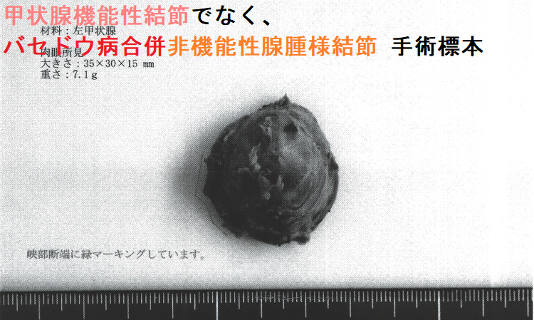 甲状腺機能性結節でなく、バセドウ病合併非機能性腺腫様結節 手術標本1 甲状腺機能性結節でなく、バセドウ病合併非機能性腺腫様結節 手術標本1