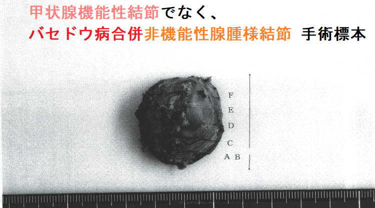 甲状腺機能性結節でなく、バセドウ病合併非機能性腺腫様結節 手術標本3 甲状腺機能性結節でなく、バセドウ病合併非機能性腺腫様結節 手術標本3