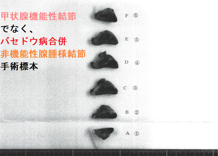 甲状腺機能性結節でなく、バセドウ病合併非機能性腺腫様結節 手術標本 (割面) 甲状腺機能性結節でなく、バセドウ病合併非機能性腺腫様結節 手術標本 (割面)