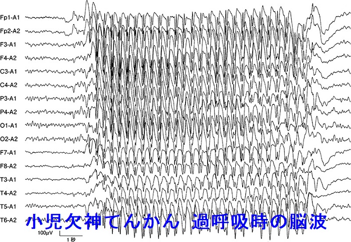 小児欠神てんかん 過呼吸時の脳波 小児欠神てんかん 過呼吸時の脳波