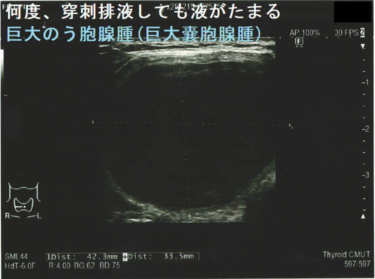 何度、穿刺排液しても液がたまる巨大のう胞腺腫(巨大嚢胞腺腫)(水平断) 何度、穿刺排液しても液がたまる巨大のう胞腺腫(巨大嚢胞腺腫)(水平断)