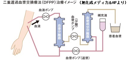 2重濾過膜血漿交換(DFPP) 
