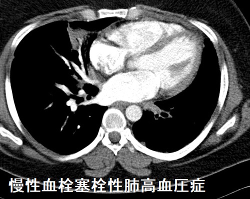 慢性血栓塞栓性肺高血圧症 CT画像