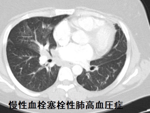 慢性血栓塞栓性肺高血圧症 CT画像