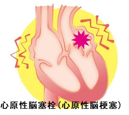 心原性脳塞栓(心原性脳梗塞) 心原性脳塞栓(心原性脳梗塞)