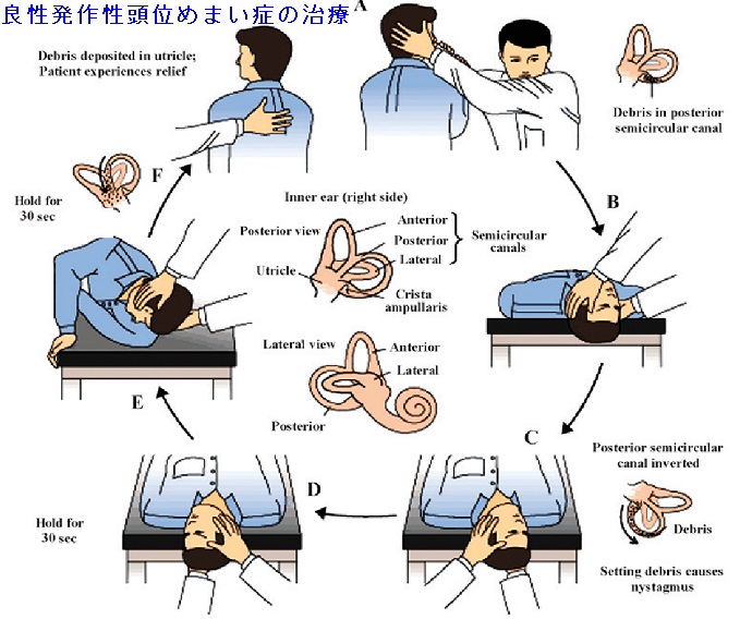 良性発作性頭位めまい症