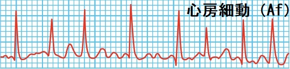 心房細動（Af）心電図